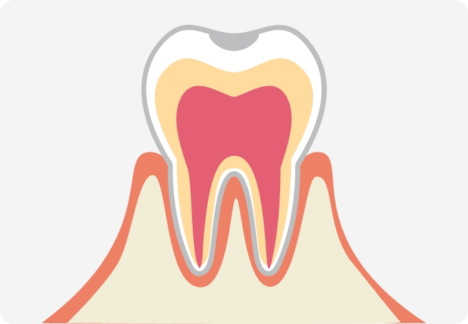 C0（初期のむし歯）
