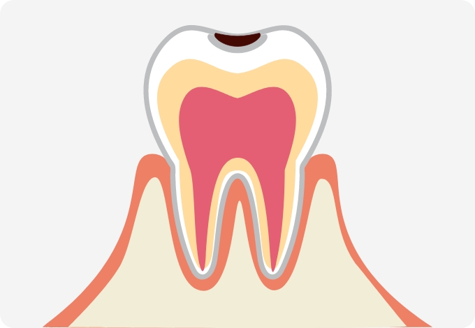 C1（エナメル質のむし歯）