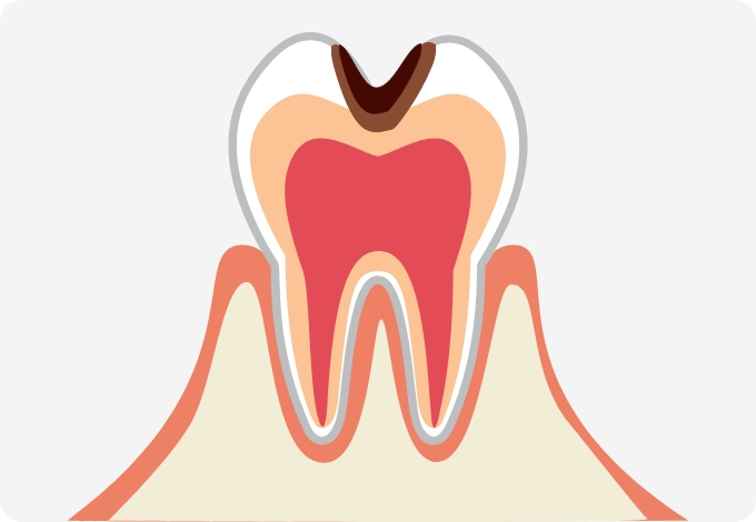 C2（象牙質のむし歯）