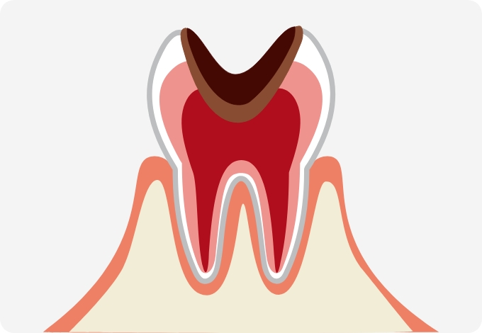 C3（歯の神経まで達したむし歯）