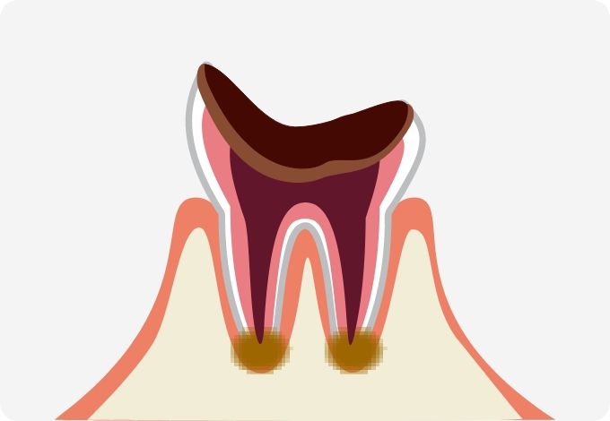 C4（歯の根だけの状態になったむし歯）